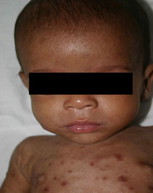 An infant with early congenital syphilis who has characteristic perioral lesions and the frontal bossing of hydrocephalus.