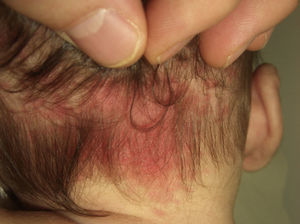 Erythematous macule on the back of the neck, one of the most common sites for the salmon patch.