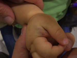 Venous malformation: a raised bluish lesion in the first interdigital space of the right hand, easily compressed.