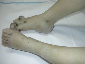 Multiple venous lesions should raise suspicion of blue rubber bleb nevus syndrome (Bean syndrome), which is characterized by the association of multiple visceral lesions, mostly affecting the digestive system.