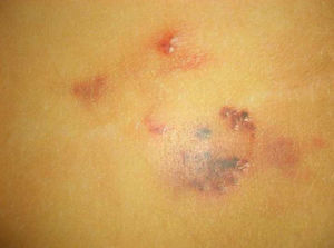 The presence of pseudovesicles, some of which contain blood due to their connection to the venous system, reveals an underlying microcystic lymphatic malformation.