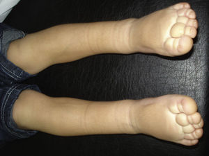 Primary lymphedema on the lower limbs (Milroy disease).