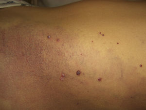 Capillary lymphatic malformation: malformation on the abdomen dotted with small angiokeratoma-like lesions.