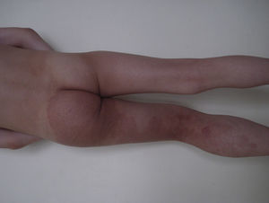 Hemihypertrophy affecting the leg, accompanied by a capillary malformation. Magnetic resonance angiography showed an underlying arteriovenous malformation (Parkes-Weber syndrome).
