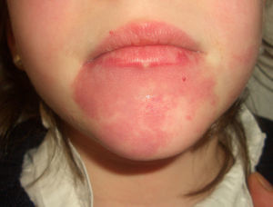 Capillary malformation (port-wine stain) on the chin.