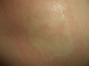 Area of skin containing a whitish central macular area corresponding to a nevus anemicus.