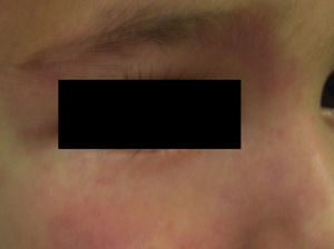 Pinkish erythematous lesion on the face corresponding to a nevus roseus; the color is slightly paler than that of a port-wine stain, but the 2 lesions can sometimes be impossible to distinguish.
