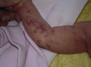Violaceous linear lesions on an arm corresponding to localized cutis marmorata telangiectatica congenita.