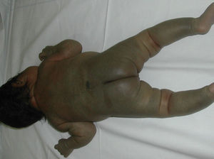 Large Mongolian spot in association with a capillary malformation on the upper back. Happle