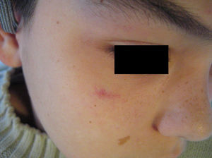Arborizing telangiectasia on the right cheek close to the eyelid.
