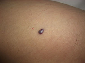 Solitary violaceous lesion with the slightly keratotic surface characteristic of a solitary angiokeratoma.
