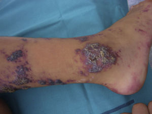 Verrucous hemangioma: a violaceous linear lesion on a leg, present since birth, with a considerable verrucous component.