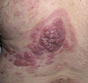 Several tumors and plaques surrounded by erythematous macules in the lumbar region and on the left flank.
