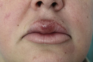 Persistent swelling of the upper lip in patient 6.
