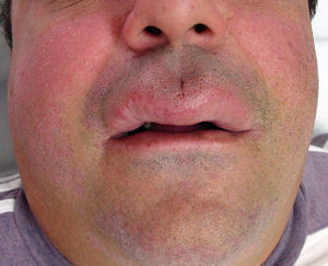 Edema of the upper lip in patient 1.