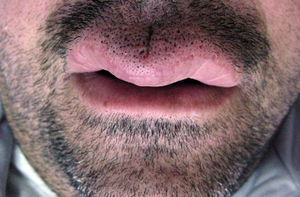 Swelling of the upper lip in patient 5.
