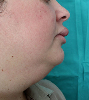 Involvement of the perioral region, including the submandibular region and both cheeks in patient 6.