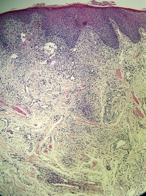 Granulomatous dermatitis with superficial and deep mixed perivascular infiltrate in patient 5 (hematoxylin-eosin, original magnification ×40).