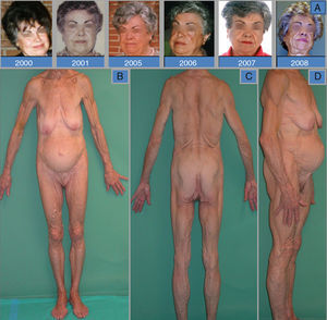 A, Progressive loss of facial fat that can first be appreciated in the photographs from 2006 and that is particularly noticeable in the year prior to diagnosis. B, C, and D, Anterior, posterior, and lateral whole-body photographs showing almost complete loss of the subcutaneous cellular tissue. The lateral photograph (D) shows marked abdominal prominence.