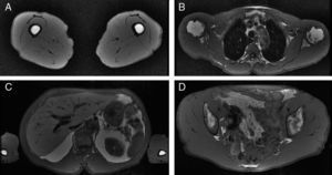 T1-weighted magnetic resonance images. A, Thighs, showing preservation of the intramedullary fat with an absence of subcutaneous and interfascicular fat. B, Thorax, with reduced intrathoracic fat and loss of subcutaneous adipose tissue. C, Abdomen with intraperitoneal fat, hepatomegaly, and an absence of subcutaneous fat. D, Pelvis: gluteal muscles of normal size.