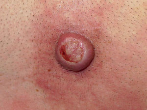 Erythematous-violaceous nodule on the chest with a rolled erythematous border and central ulceration.