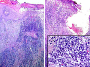 Nodular lesion with central ulceration covered by fibrin. The nodule had a major vascular component and a predominantly perivascular basophilic inflammatory infiltrate, but the architecture of the lesion was not lobular. Inset: Detail of the plasma cell infiltrate.