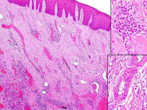 Dilated capillaries and venules with focal endothelial prominence and vacuolization (lower inset). Russell bodies in the inflammatory infiltrate (upper inset).