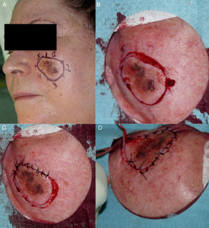 A-D, Excision of a strip of skin around the lesion, by sectors, and suture of the defect.