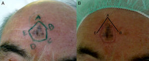 A, Design of a pentagonal strip of skin to be excised and analyzed. B, Appearance of the lesion at 10 days, prior to a second operation to locate the superior margin of the lesion.