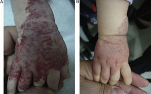 Patient number 3. (A) Start at two-months and (B) one-year follow-up.