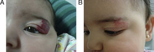 Patient number 26. (A) Start at two months and (B) fifth-month follow-up.