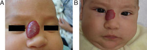 Patient number 34. (A) Start at two-months and (B) second-month follow-up.