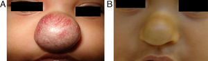 Patient number 37. (A) Start at five months and (B) sixth-month follow-up.