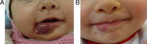 Patient number 42. (A) Start at 4 months and (B) ninth-month follow-up.