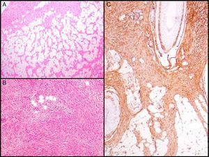 Histologic images of dermatofibrosarcoma. A, Honeycomb infiltration of subcutaneous cell tissue (hematoxylin and eosin, original magnification ×40). B, Fibrosarcomatous pattern in dermatofibrosarcoma (hematoxylin and eosin, original magnification ×100). C, Staining with CD34 in dermatofibrosarcoma (hematoxylin and eosin, original magnification ×100).