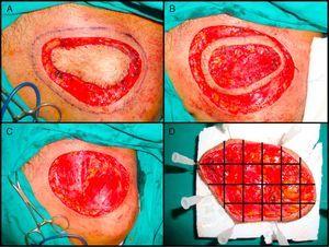 Slow Mohs surgery for dermatofibrosarcoma protuberans. A, Debulking or narrow-margin excision of the tumor. B, First stage of the Mohs procedure. Mapped ring of clinically healthy skin. C, Surgical defect after first stage. Exposure of the muscle plane. D, Division of the specimen by the pathologist.