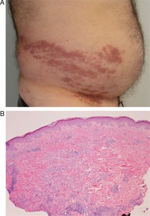 Case 2: A, Purplish-brown plaques on the right flank, coalescing on the T10 dermatome. B, Case 2 Lymphohistiocytic perivascular and interstitial infiltrate (hematoxylin-eosin, original magnification x10).