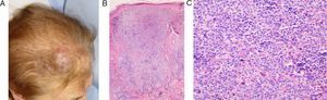 Case 7: A, Erythematous-violaceous tumorous lesion in the right frontal area, in the region of the first branch of the trigeminal nerve. B, Lymphoid tumorous infiltration occupying the superficial and deep dermis and forming large groups with a follicular appearance (hematoxylin-eosin, original magnification x10). C, Small-to-medium-sized atypical lymphocytes arranged in follicular groups (hematoxylin-eosin, original magnification x20).