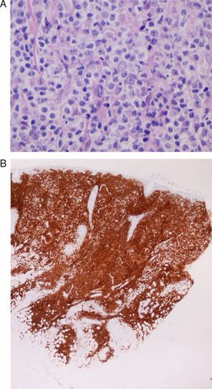 Case 9: A, Medium-to-large-sized lymphoid cells with prominent nuclei and nucleoli, presenting mitotic activity (hematoxylin-eosin, original magnification x20). B, Diffuse CD5-positive tumorous infiltrate in the dermis, which corresponds to the skin infiltration by the patient's B-cell chronic lymphocytic leukemia (CD5 marker, original magnification x4).