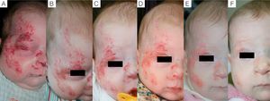Case 1. A, Segmental hemangioma on the face, occluding the eye before treatment with propranolol. B, After 5 days of treatment the eye is beginning to open. C, At 12 days the eye is nearly open and the hemangioma is clearing. D, After 3 months of treatment. E, At 6 months. F, At 11 months (1 month after end of treatment).