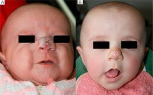 Case 2. A, Hemangioma on the tip of an infant's nose, before starting treatment with propranolol. B, Outcome of 6 months of treatment.