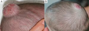 Case 6. A, Scalp hemangioma before treatment with propranolol. B, Excellent results after 6 months.