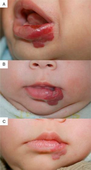 Case 10. A, Ulcerated hemangioma on the lower lip. B, Hemangioma after 2 months of treatment with propranolol. C, The color has faded and there is slight residual scarring at 6 months.