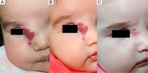 Case 11. A, Hemangioma involving the medial angle of the eye before treatment with propranolol. B, Response to 15 days of treatment. C, Response at 4 months.