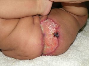 Ulcer with erythematous-violaceous borders and a shiny base in the left perianal region.