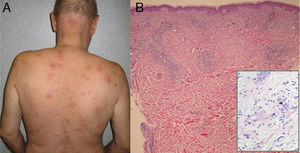 A, Several erythematous, edematous plaques with a central purple area on the trunk. B, Diffuse, mixed leukocytic infiltrate involving the full thickness of the dermis (original magnification ×40). At a higher magnification (inset), leukocytoclasia and vasculitis are visible.