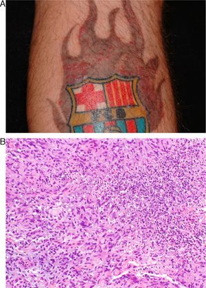 Patient 1. A, Papulopustules only affecting the gray area of the flame. B, Granuloma with abscess formation and occasional giant cells (hematoxylin-eosin, original magnification×200).