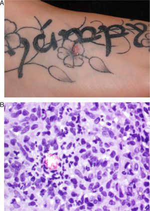 Patient 2. A, Erythematous papule in the gray area of a petal of the flower. B, Accumulation of acid-alcohol-fast bacteria in the area with abscess formation (Kinyoun, original magnification×400).