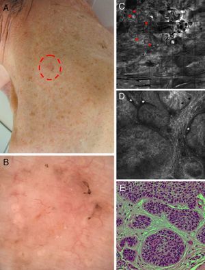Correlation of clinical, dermoscopic, and reflectance confocal microscopy (RCM) images of a pigmented basal cell carcinoma (BCC) in an immunosuppressed patient after kidney transplantation. (A) Clinical image showing a flat erythematous plaque on the neck with brown pigmentation around the periphery of the lesion. (B) Dermoscopy reveals fine telangiectasias in the center and brown pigmentation at the border of the lesion. (C) RCM mosaic obtained at the level of the superficial dermis (4mm×4mm) shows multiple hyporefractile tumors islands in the upper dermis (red arrowheads). (D) On a single RCM image (0.5mm×0.5mm) these tumor islands display elongated nuclei with peripheral palisading (black arrowheads) and are separated from the surrounding stroma by dark, cleft-like spaces (white asterisk). (E) Hematoxylin–eosin histology shows tumor nodules comprising basaloid tumor cells with peripheral palisading and surrounding fibrous stroma.