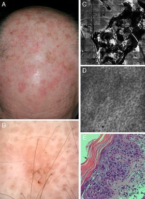 Correlation of clinical, dermoscopic, and reflectance confocal microscopy (RCM) images of an actinic keratosis (AK). (A) Clinical image reveals multiple erythematous to brown hyperkeratotic plaques on the scalp. (B) Dermoscopy reveals a brownish erythematous plaque with central scale lacking the classical strawberry pattern typical of AK. (C) RCM mosaic of the lesions obtained at the granular and spinous layer shows a central area of hyperkeratosis with amorphous material of medium to high reflectance. (D) RCM single image obtained at the periphery of the lesion demonstrates a broadened (black asterisk) and generally atypical honeycomb pattern with variations in cell and nuclei sizes and shapes. (E) Corresponding hematoxylin–eosin histology illustrates overlying hyperparakeratosis (black arrow) and epidermal proliferation of atypical keratinocytes.